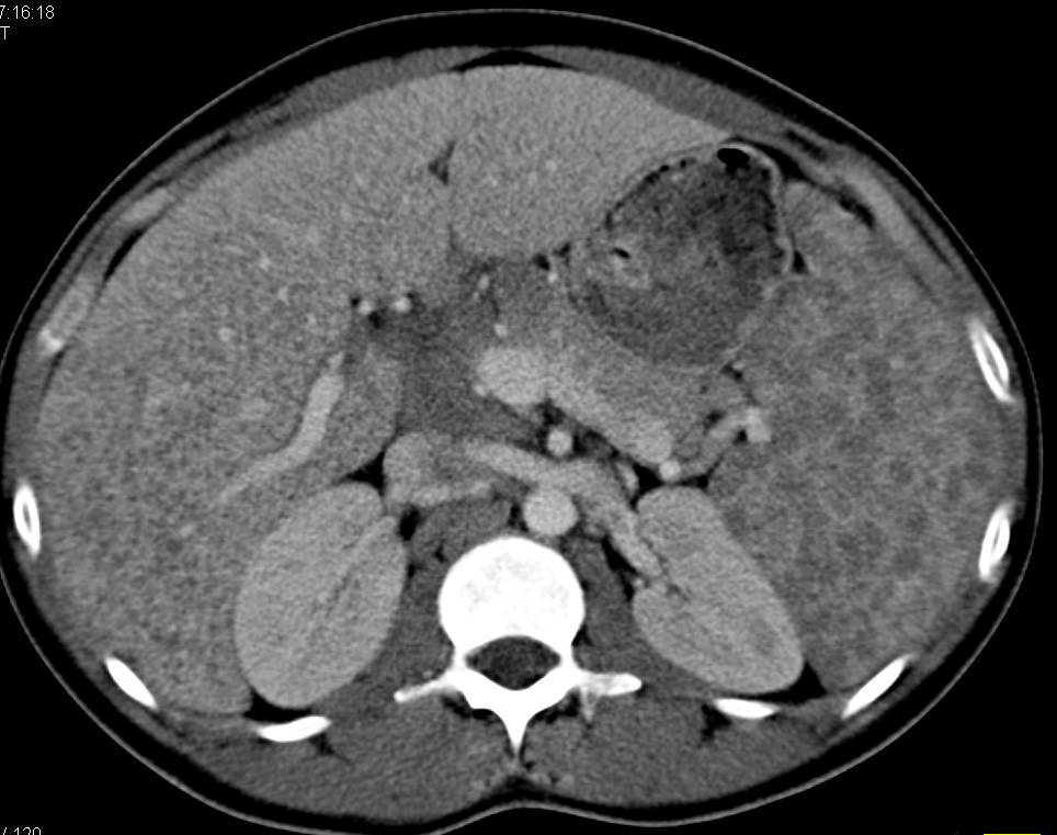 Sarcoidosis Involves the Spleen and Liver - CTisus CT Scan