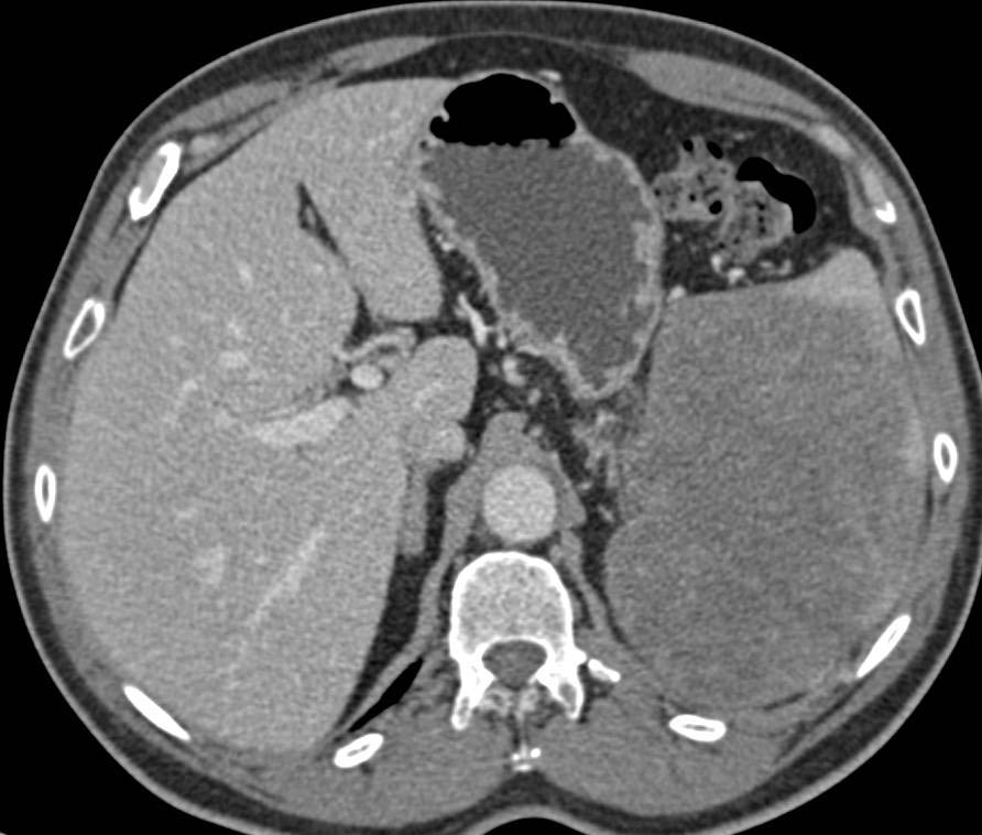 Primary Splenic Lymphoma - CTisus CT Scan