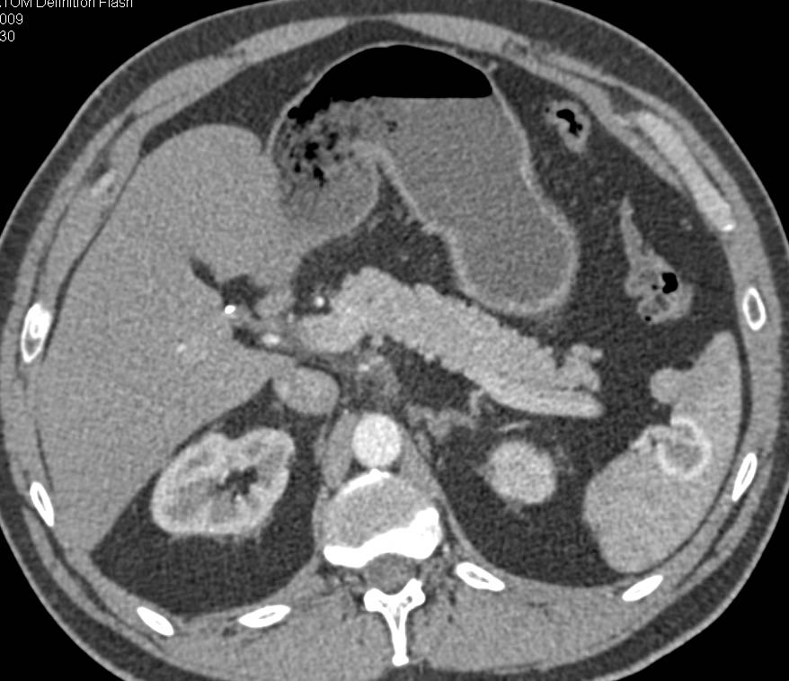 Splenic Hemangioma - CTisus CT Scan