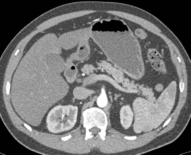 Accessory Spleen - CTisus CT Scan