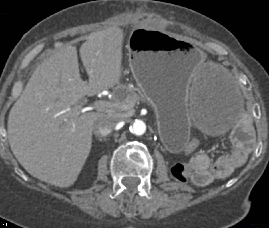 Left Upper Quadrant Abscess in Patient s/p Distal Pancreatectomy and Splenectomy - CTisus CT Scan