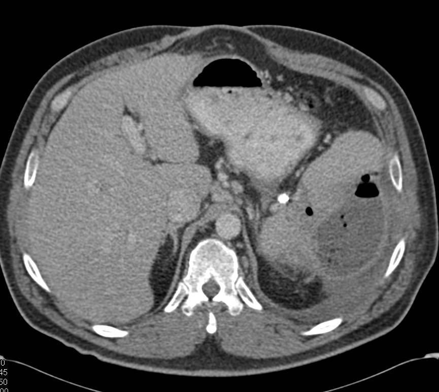 Infected Splenic Hematoma - CTisus CT Scan