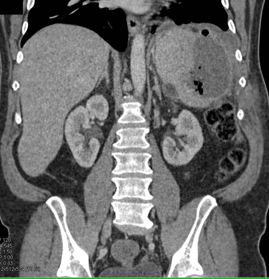 Infected Splenic Hematoma - Spleen Case Studies - CTisus CT Scanning