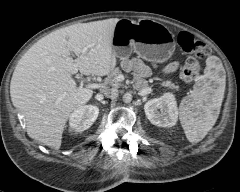 Sarcoidosis of the Spleen - CTisus CT Scan