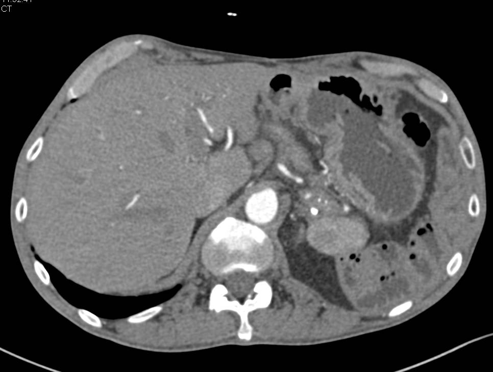 Splenosis Simulates a Mass in a Patient with Prior Splenectomy - CTisus CT Scan