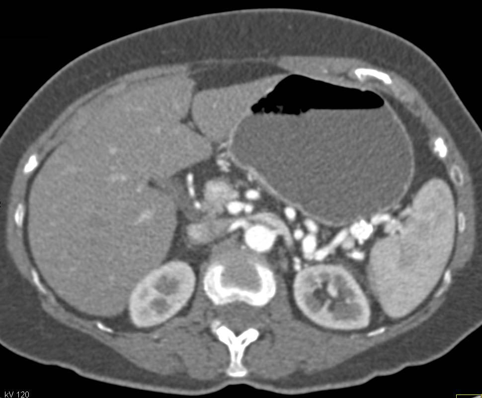Multiple Splenic Artery Aneurysms - CTisus CT Scan