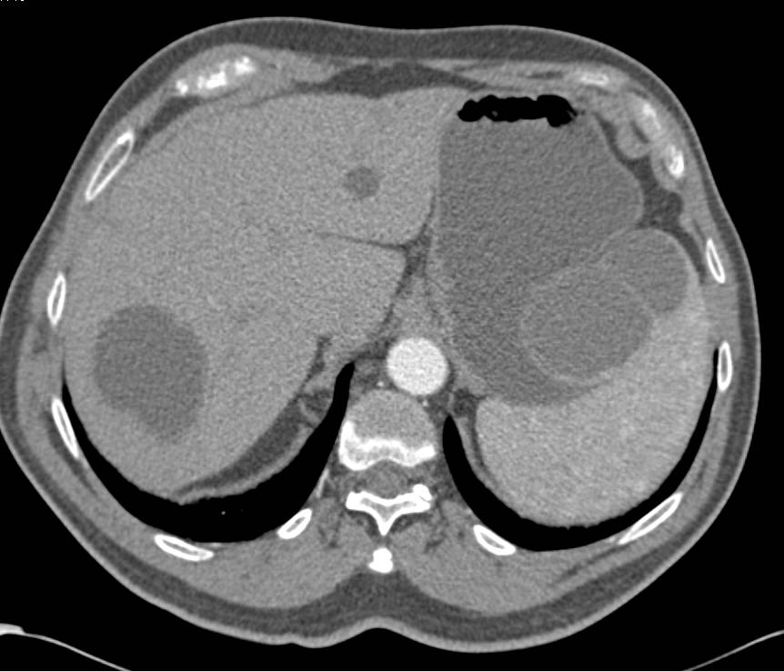 Splenic Cysts - CTisus CT Scan