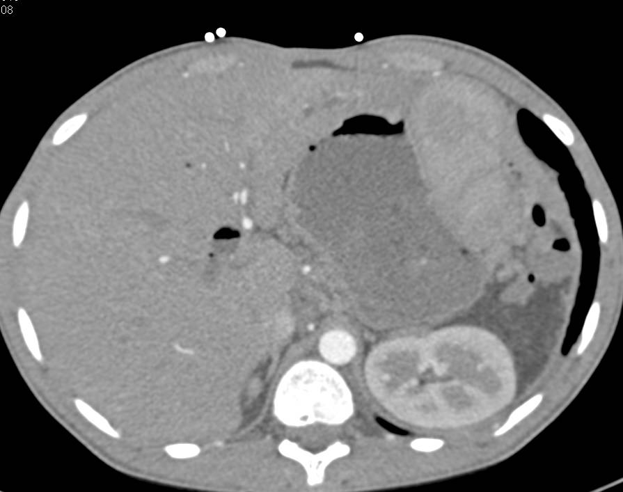 Splenosis in the Left Upper Quadrant Simulates Recurrent Tumor - CTisus CT Scan