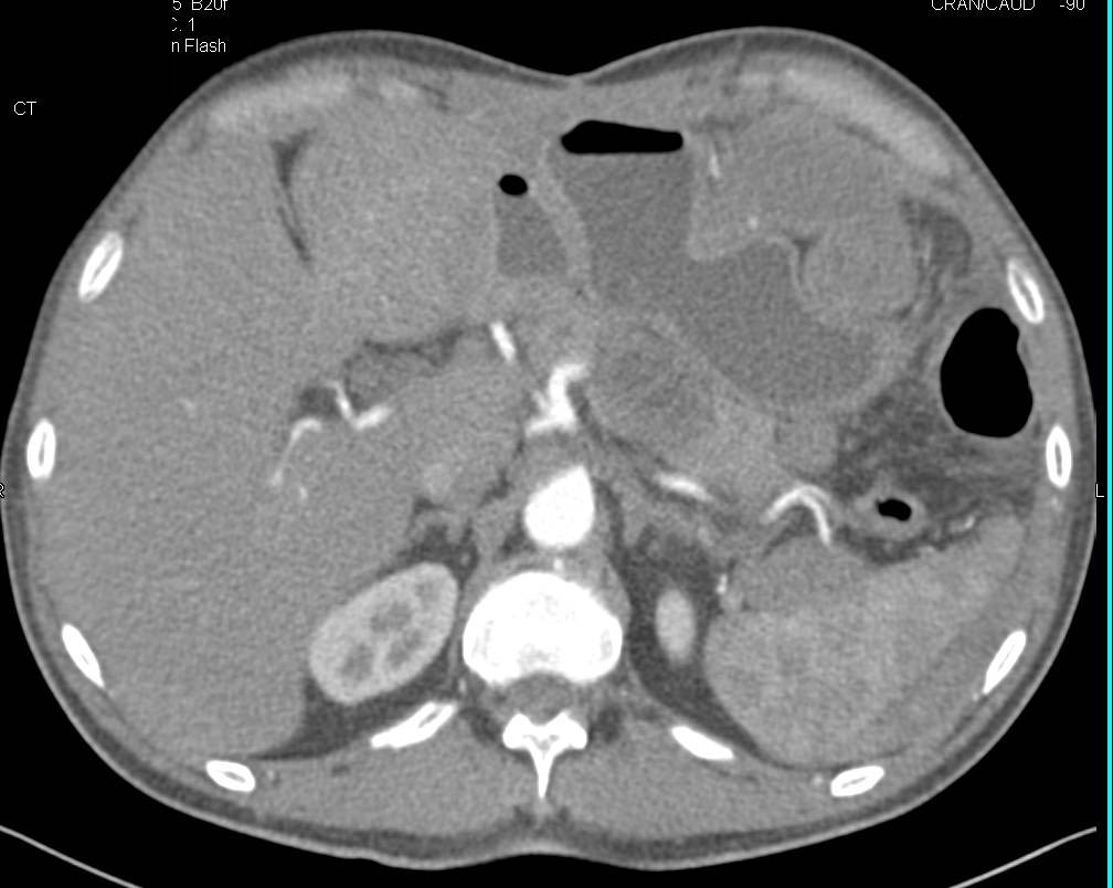 Intra-abdominal Bleed Arising from the Spleen - CTisus CT Scan