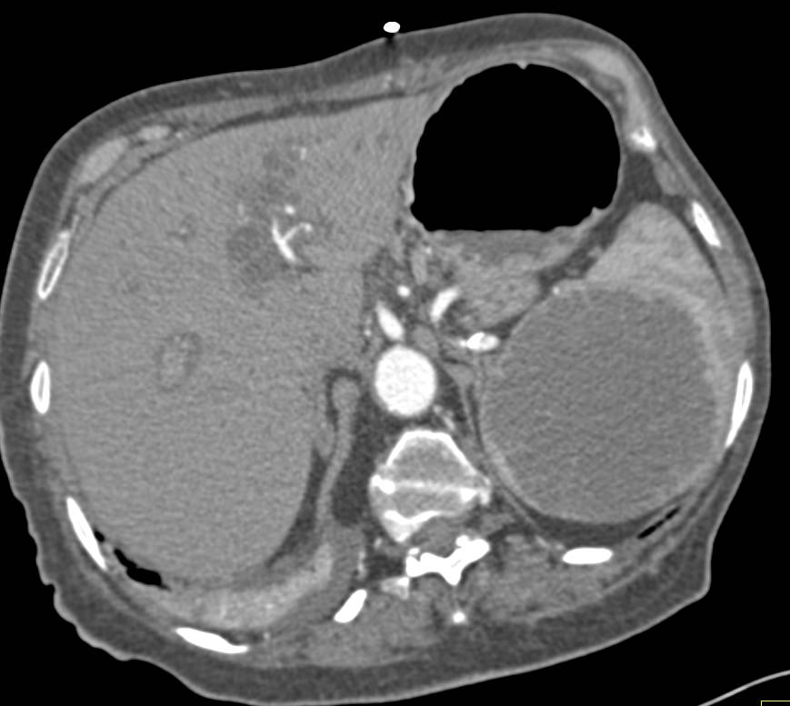 Splenic Hamartoma - Spleen Case Studies - CTisus CT Scanning