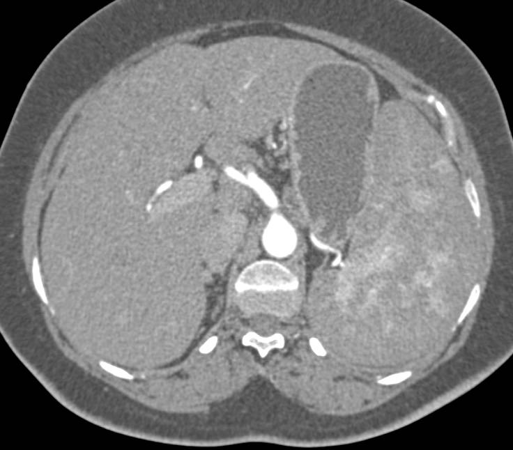 Patchy Enhancement of the Spleen in Leukemia with the Spleen Infiltrated - CTisus CT Scan