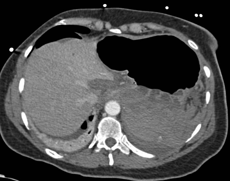 Splenic Bleed with Blood in Left Upper Quadrant - CTisus CT Scan