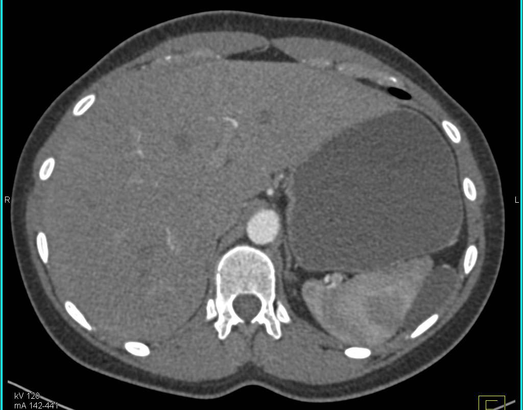 Incidental Peritoneal Cyst Adjacent to the Spleen - CTisus CT Scan