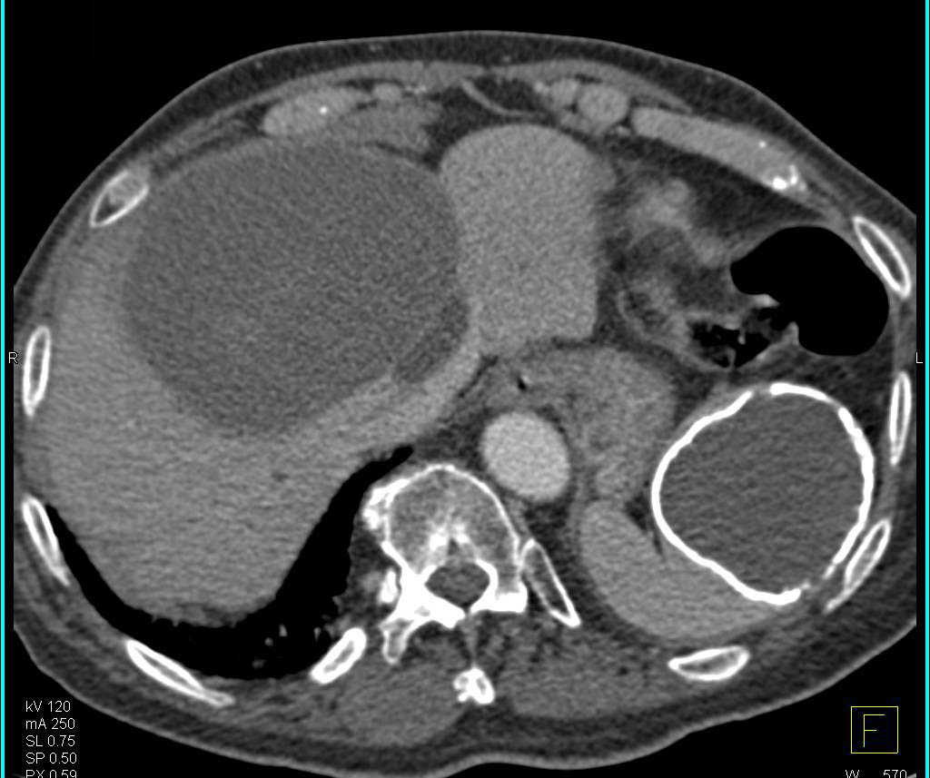 Old Splenic Hematoma - CTisus CT Scan