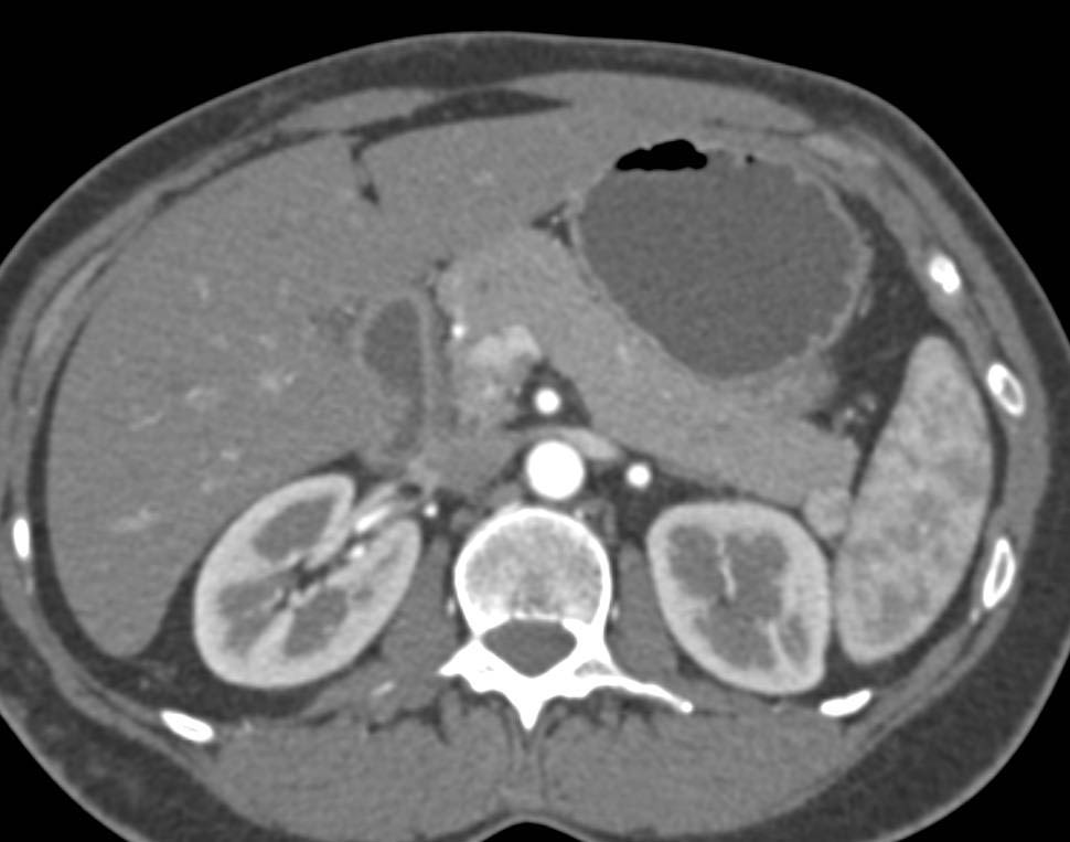 Accessory Spleen Abuts the Tail of the Pancreas and Simulates a Neuroendocrine Tumor. Watch its Appearance of the Various Phases as it Matches the Spleen so Nicely - CTisus CT Scan