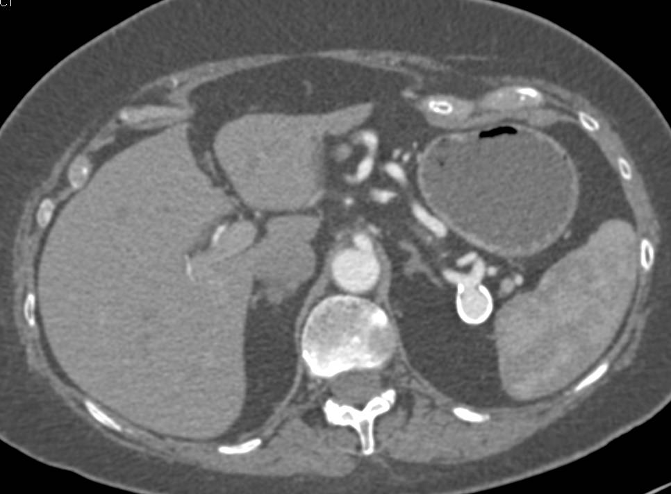 Splenic Artery Aneeurysm - CTisus CT Scan