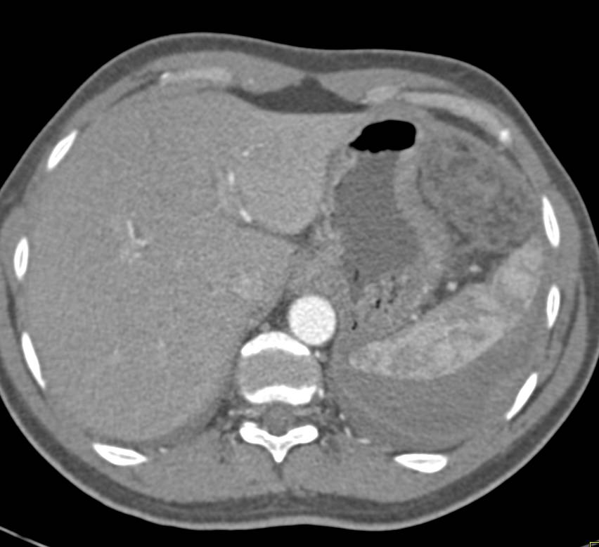 Perisplenic Bleed - CTisus CT Scan