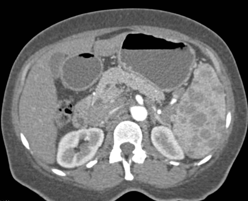 Sarcoidosis Involves the Spleen as Well as Adenopathy - CTisus CT Scan