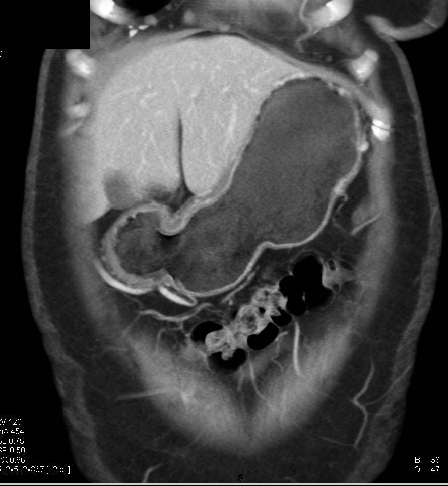 Sarcoidosis Involves the Spleen and Well as Peripancreatic Adenopathy - CTisus CT Scan