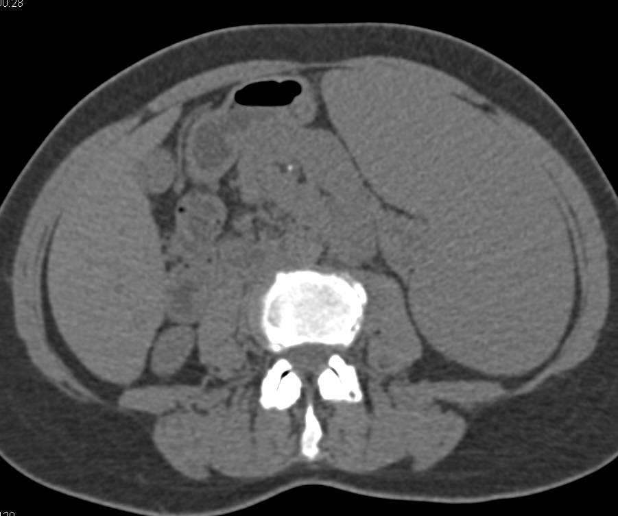 Splenic Infiltration by Lymphoma - CTisus CT Scan