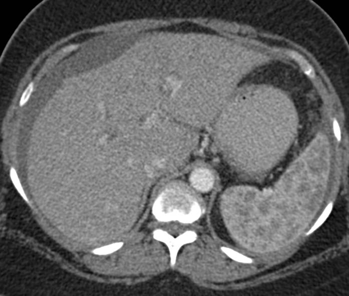 Splenic Infiltration by Sarcoidosis - CTisus CT Scan