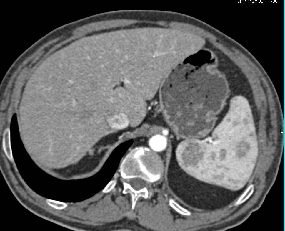 Incidental Splenic Hemangiomas - CTisus CT Scan