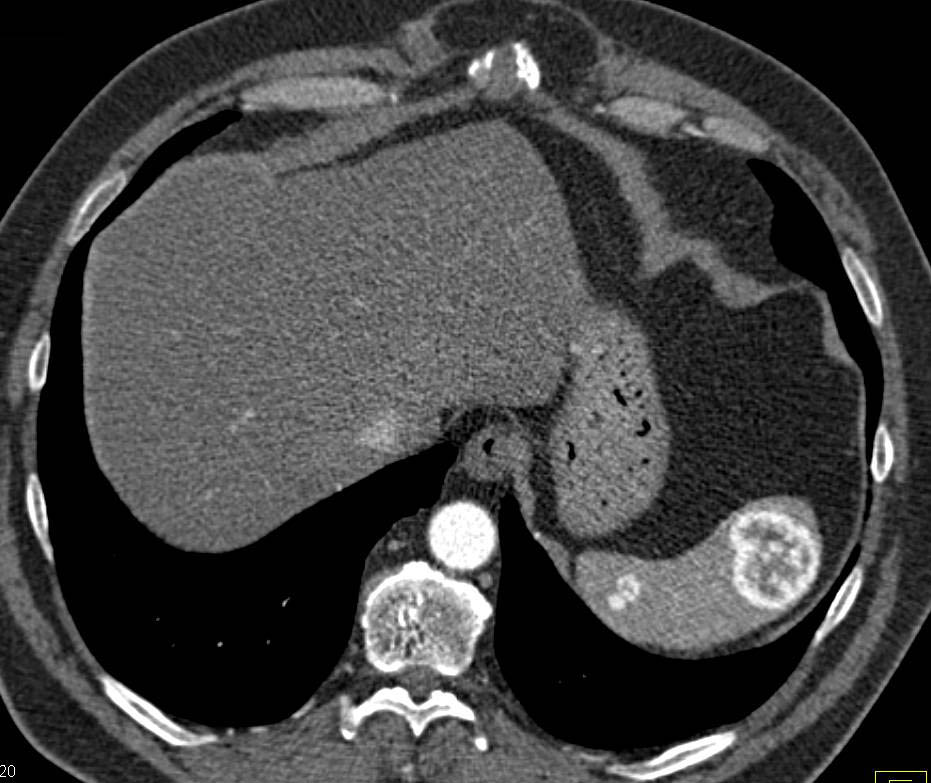 Recurrent Renal Cell Carcinoma Metastatic to the Spleen - CTisus CT Scan