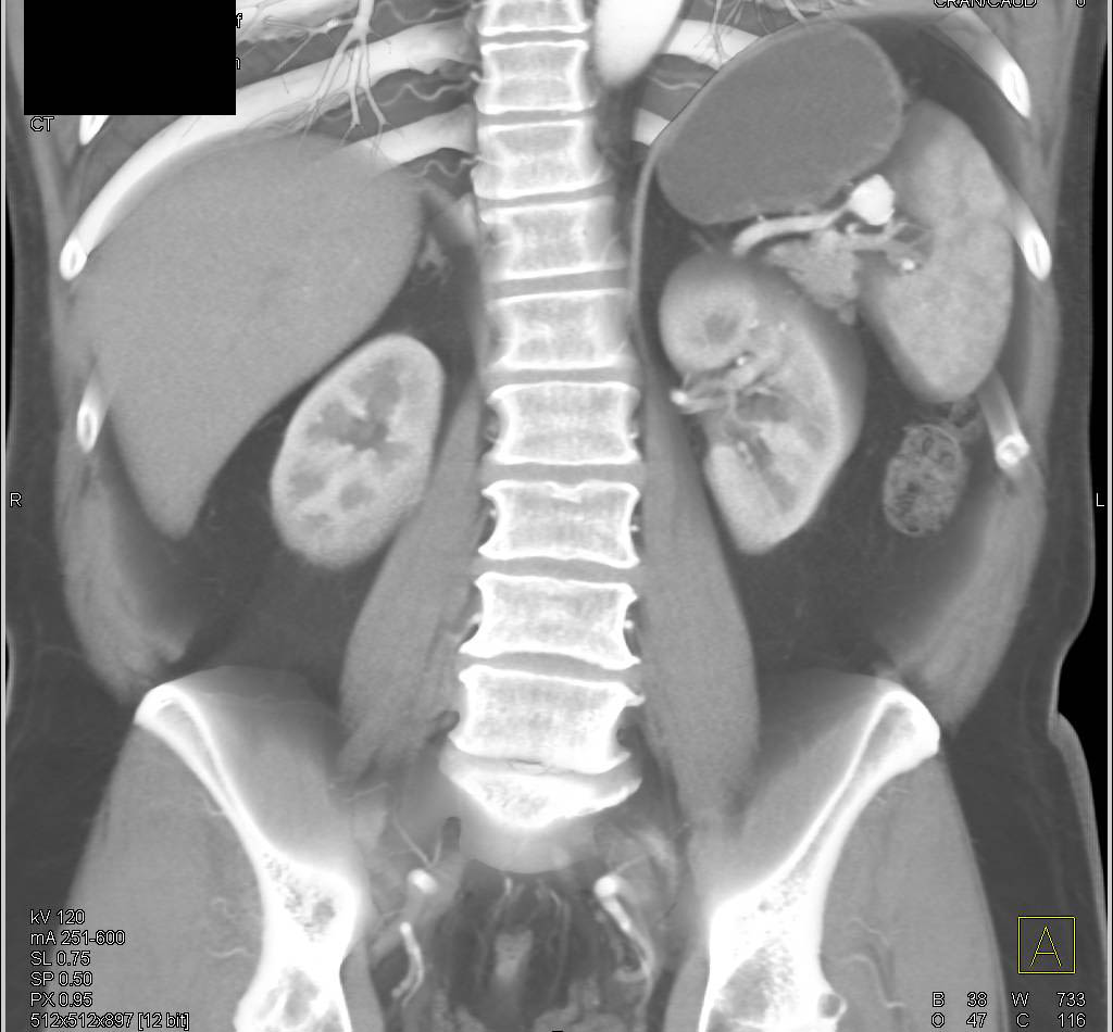 Splenic Artery Aneurysm Near Hilum of the Spleen - CTisus CT Scan