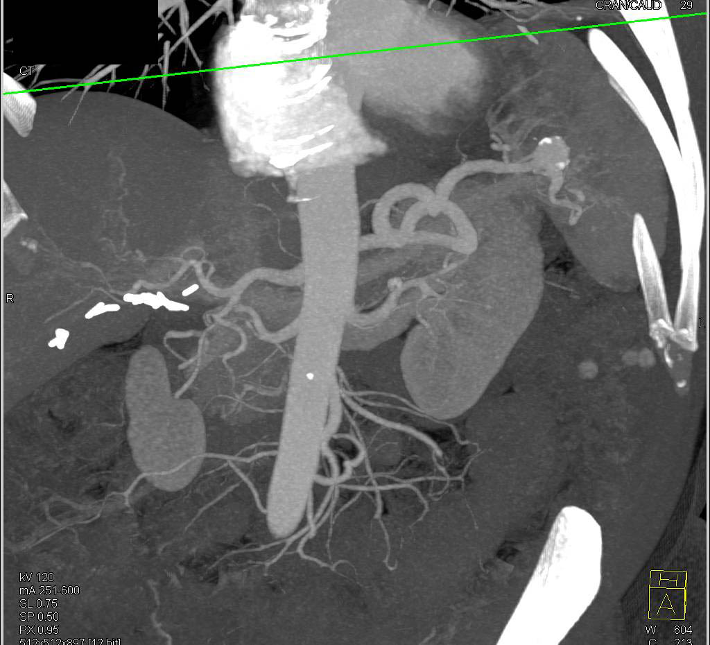Splenic Artery Aneurysm Near Hilum Of The Spleen Spleen Case Studies