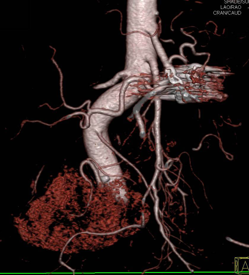 Prior Coiling of a Splenic Artery Aneurysm - CTisus CT Scan