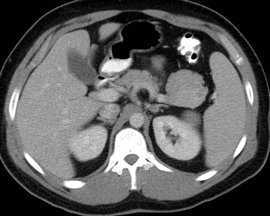 Splenule Simulates and Islet Cell tumor of the Pancreas - CTisus CT Scan