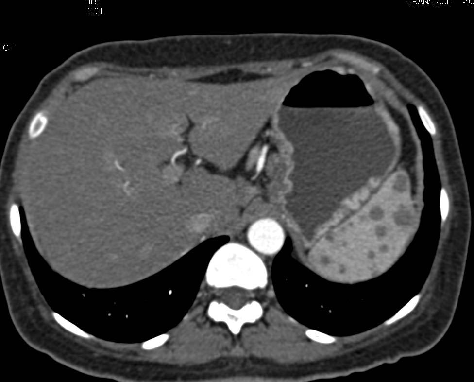Sarcoidosis with Splenic Lesions and Para-aortic Adenopathy - CTisus CT Scan