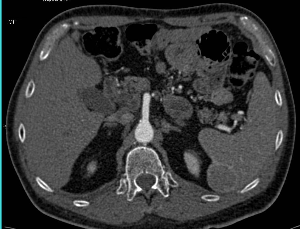 Splenic Littorial Cell Tumor - CTisus CT Scan