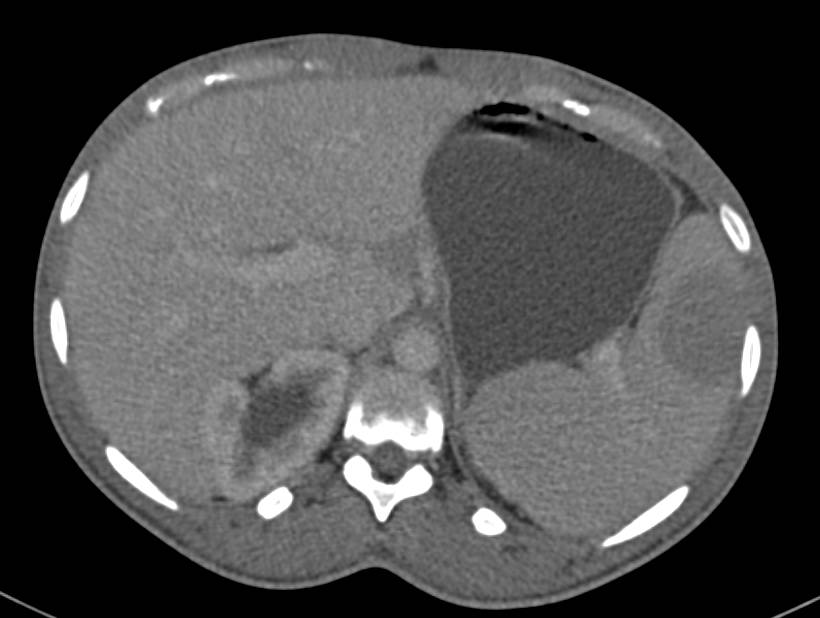 B-Cell Lymphoma with Extensive Nodes and Spienic Mass - CTisus CT Scan