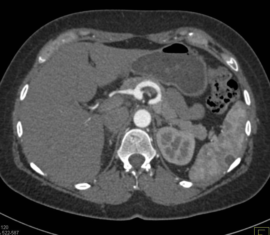 Splenic Cyst - CTisus CT Scan