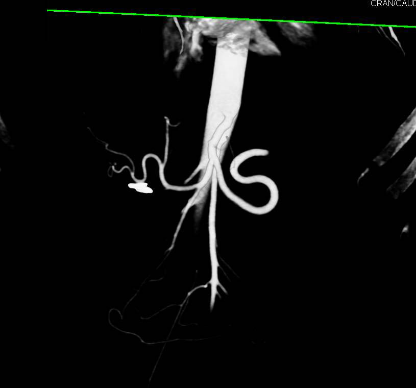 Splenic Artery with a Capital S - CTisus CT Scan