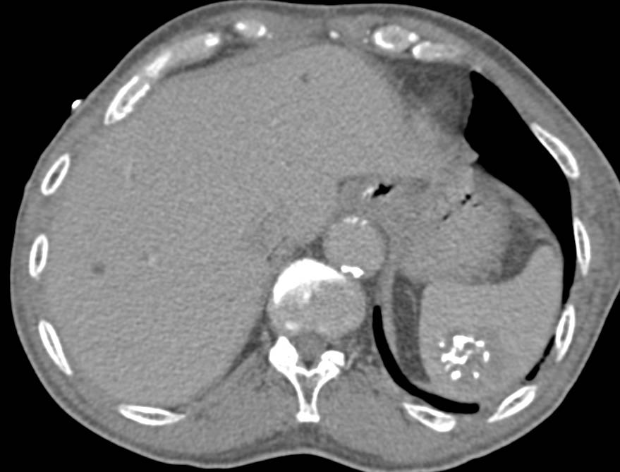 Splenic Hemangioma - CTisus CT Scan