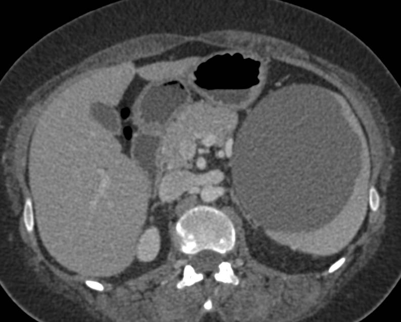 Splenic Cyst - CTisus CT Scan