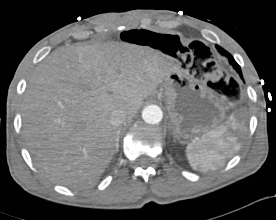 Splenic and Renal Infarcts - CTisus CT Scan