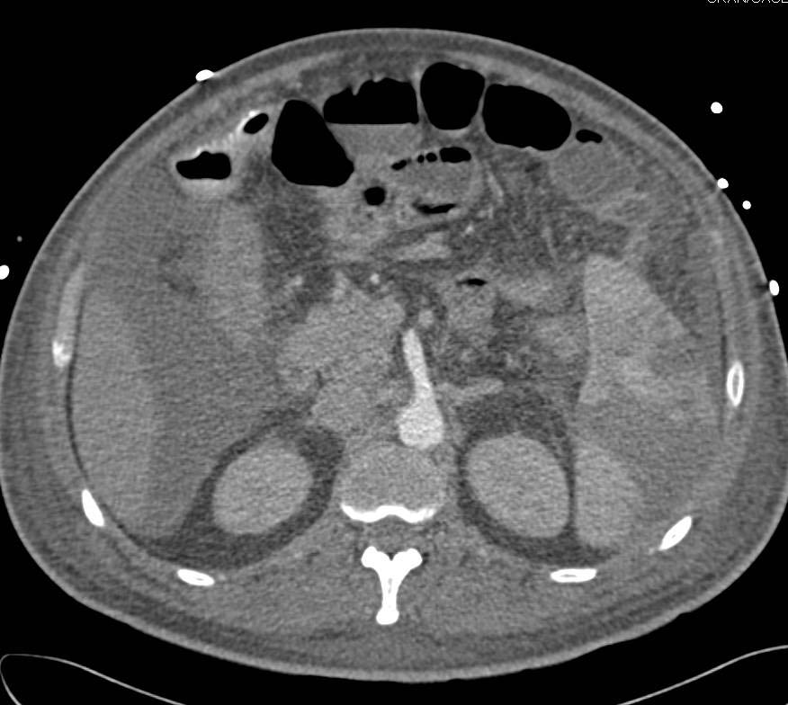 Multiple Splenic Infarcts and Ascites - CTisus CT Scan