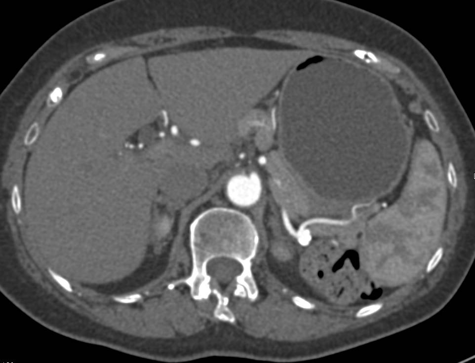 Splenic Artery Aneurysm - CTisus CT Scan