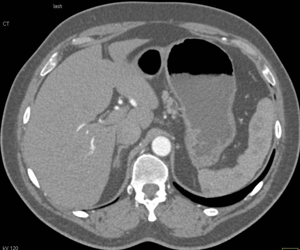 Sarcoidosis Involves the Spleen - CTisus CT Scan