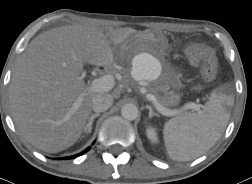 Pseudoaneurysm of the Splenic Artery - CTisus CT Scan