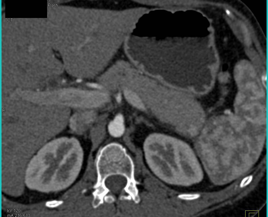 Splenule in the Tail of the Pancreas-See the Enhancement Pattern - CTisus CT Scan