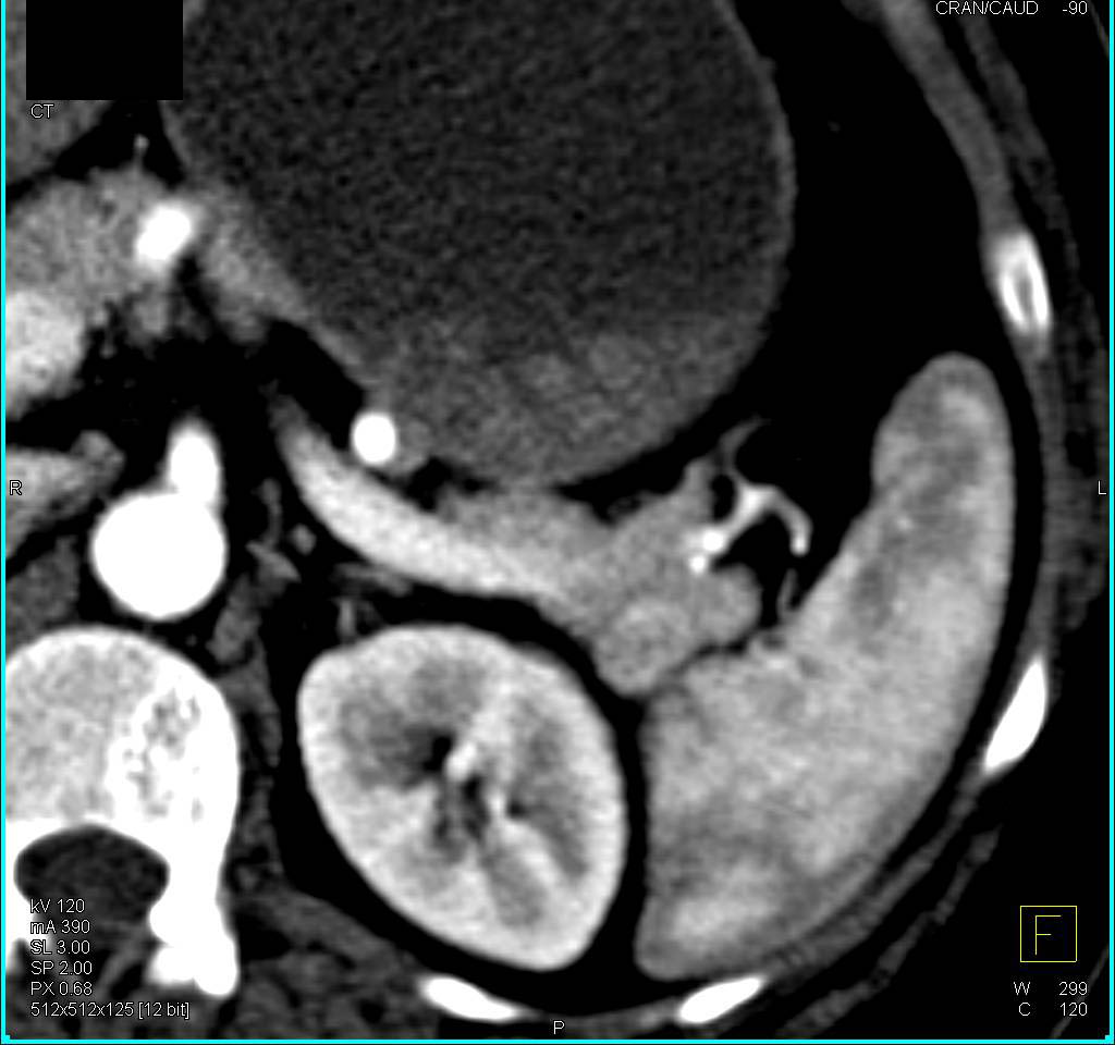 Splenule Simulates a PET Tumor - CTisus CT Scan