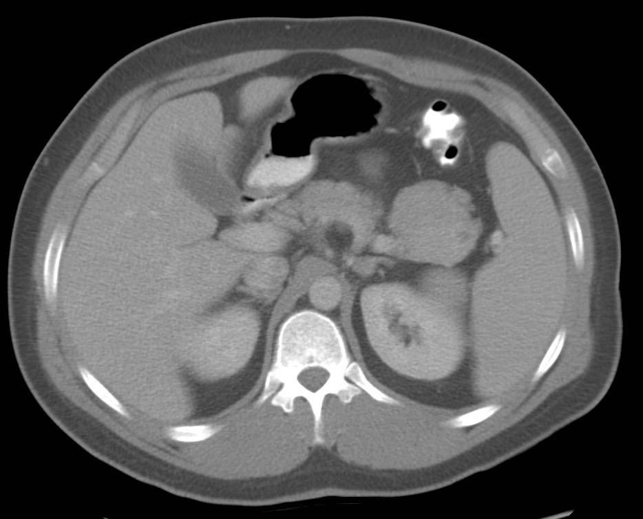 Splenule Simulates a PET Tumor - CTisus CT Scan