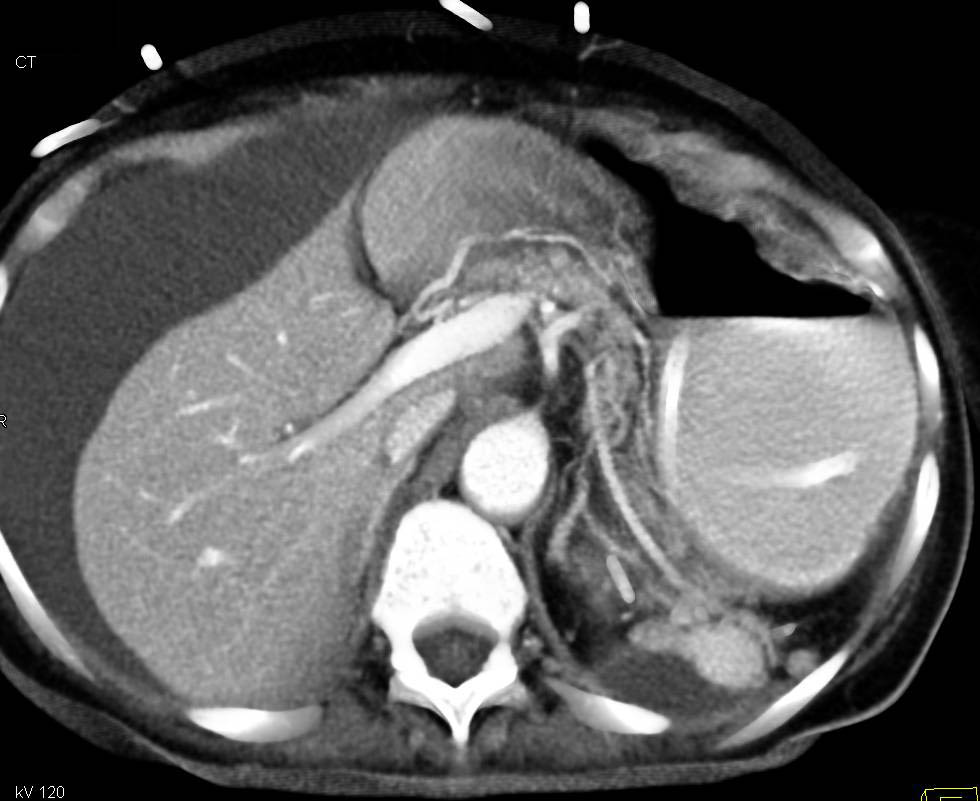 Multiple Splenules in End Stage Renal Disease (ESRD) Patient - CTisus CT Scan