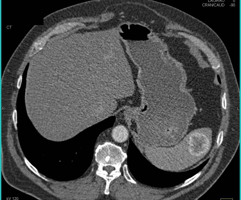 Splenic Metastases from Renal Cell Carcinoma - CTisus CT Scan