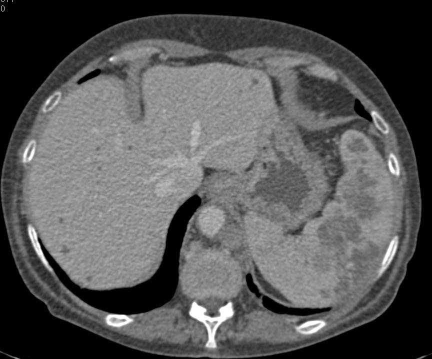 Lymphoma with Splenic Involvement and Extensive Adenopathy - CTisus CT Scan