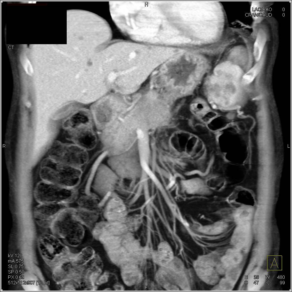 Splenic Involvement by Lymphoma with Extensive Adenopathy - CTisus CT Scan